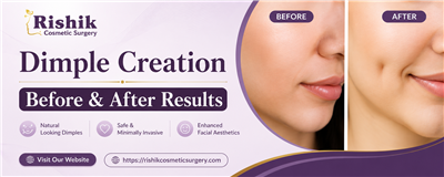 Dimple Creation Before & After Results by Dr. Shweta Jangid
