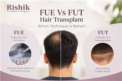 FUE Vs FUT Hair transplant: which technique is better